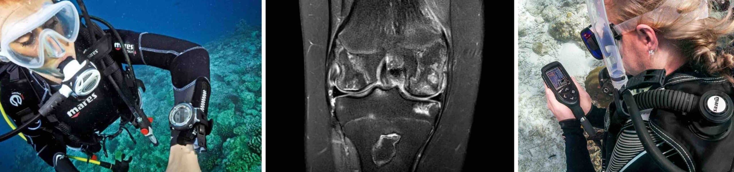 OSTEONECROSE DISBÁRICA JOELHO OSTEONECROSE DISBÁRICA JOELHO