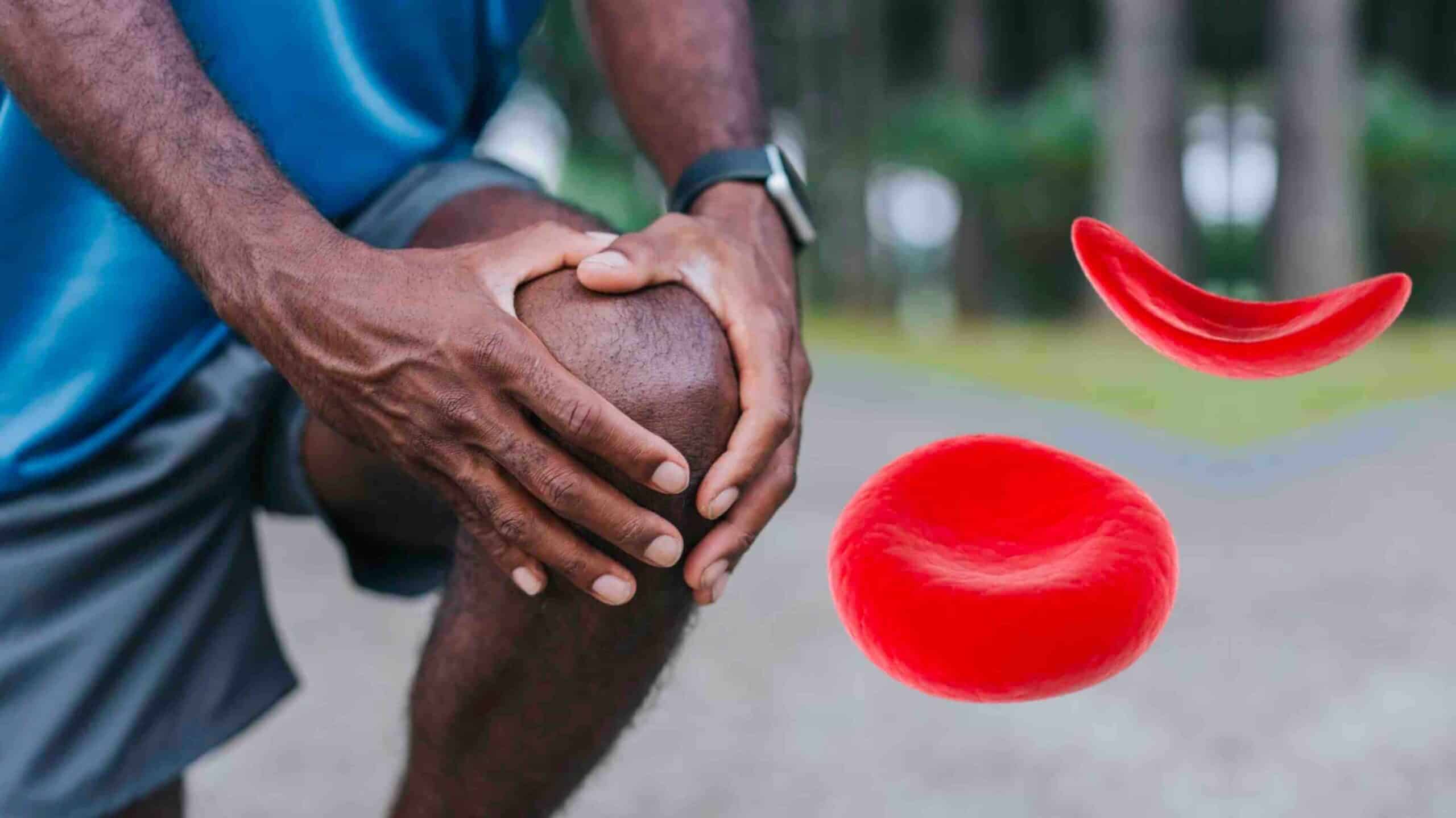DOR NO JOELHO E ANEMIA FALCIFORME DOR NO JOELHO E ANEMIA FALCIFORME