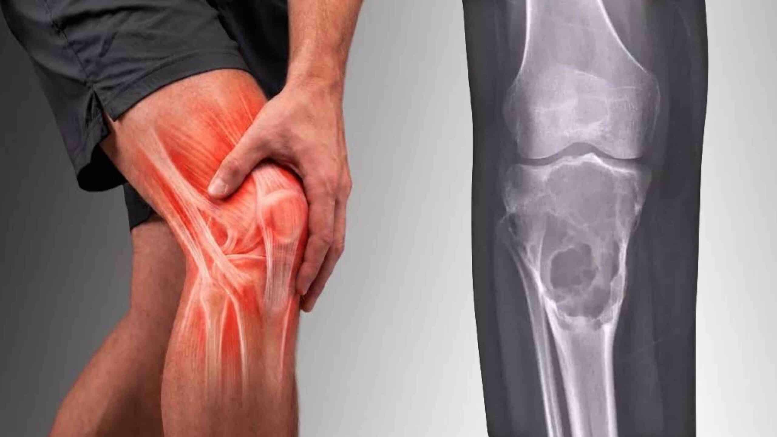 FIBROMA CONDROMIXOIDE NO JOELHO FIBROMA CONDROMIXOIDE NO JOELHO