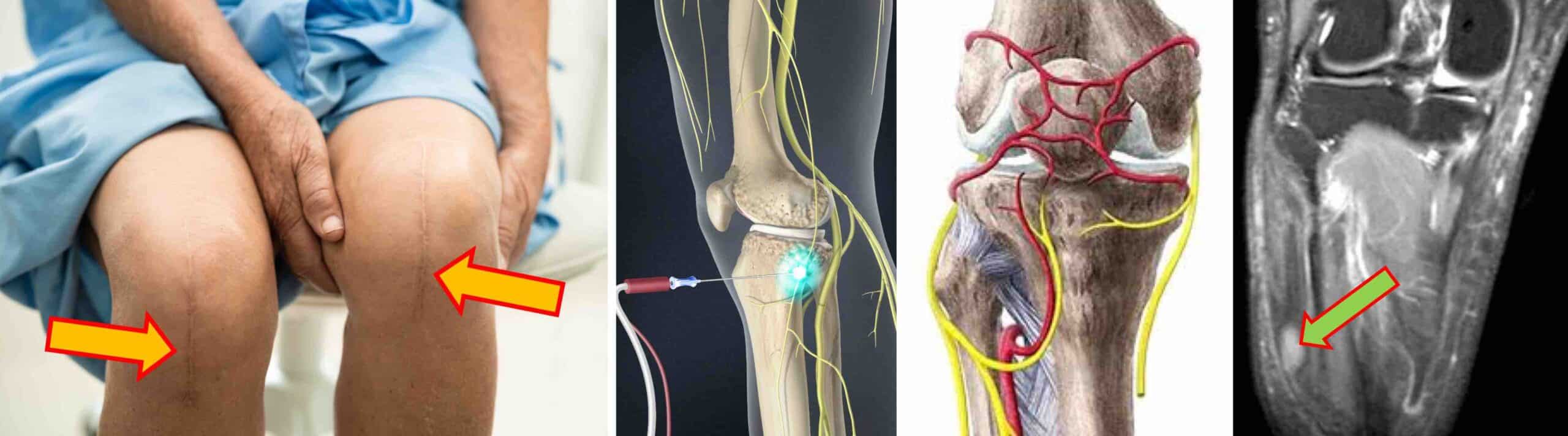 NEUROMA JOELHO NEUROMA JOELHO