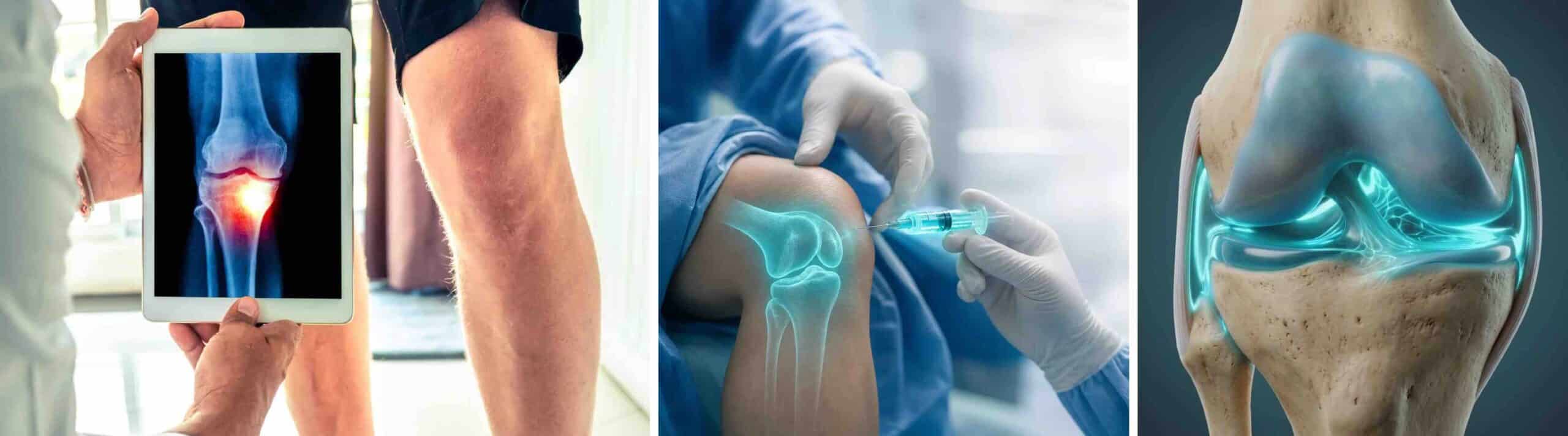 NOVAS GERAÇÕES ÁCIDO HIALURÔNICO JOELHO NOVAS GERAÇÕES ÁCIDO HIALURÔNICO JOELHO