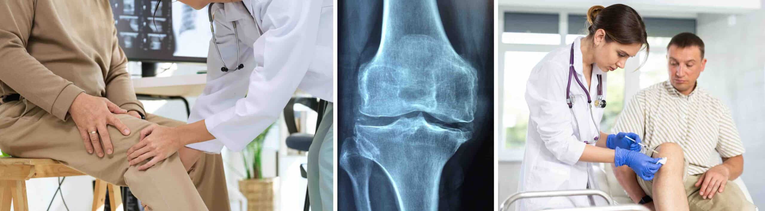 NOVO ÁCIDO HIALURÔNICO PARA JOELHO NOVO ÁCIDO HIALURÔNICO PARA JOELHO